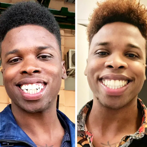 Before and after smile makeover