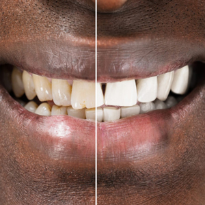 Before and after smile makeover