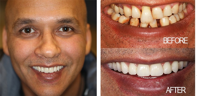 Before and after smile makeover