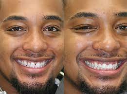 Before and after smile makeover