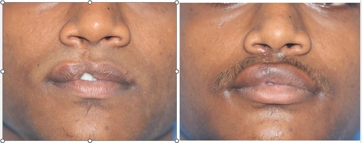 Before and after smile makeover