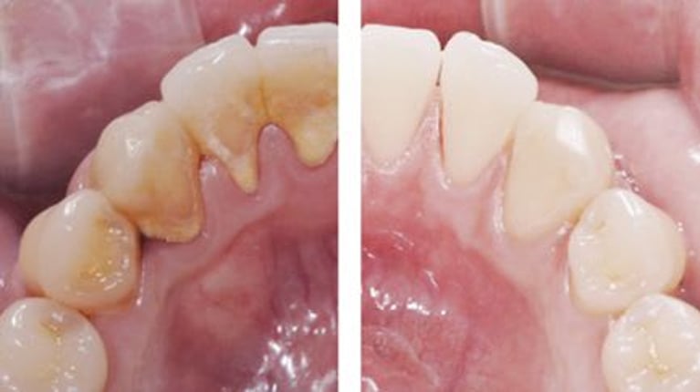 Before and after smile makeover