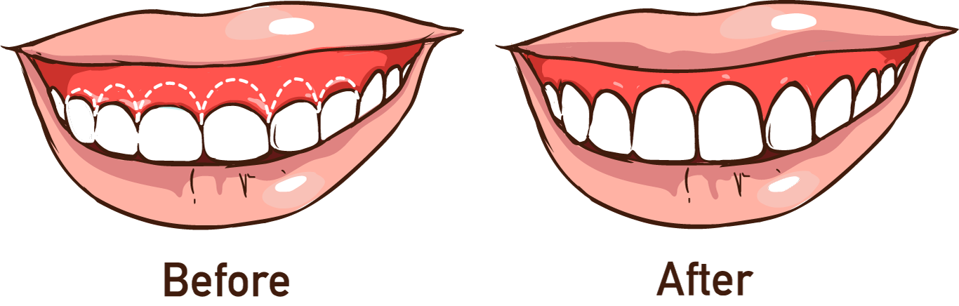 Before and after smile makeover