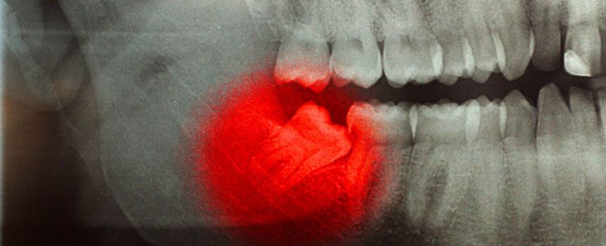 Before and after smile makeover