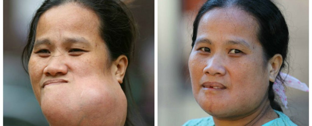 Before and after smile makeover