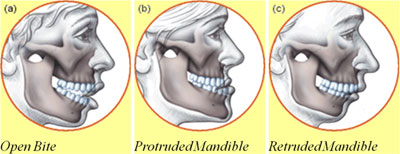Before and after smile makeover